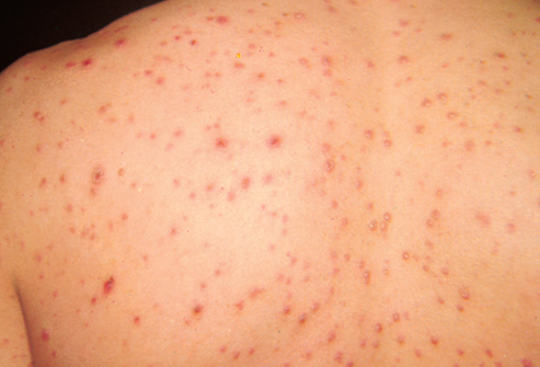 A back covered in chicken pox. Caused by the initial infection with varicella zoster virus (VZV)